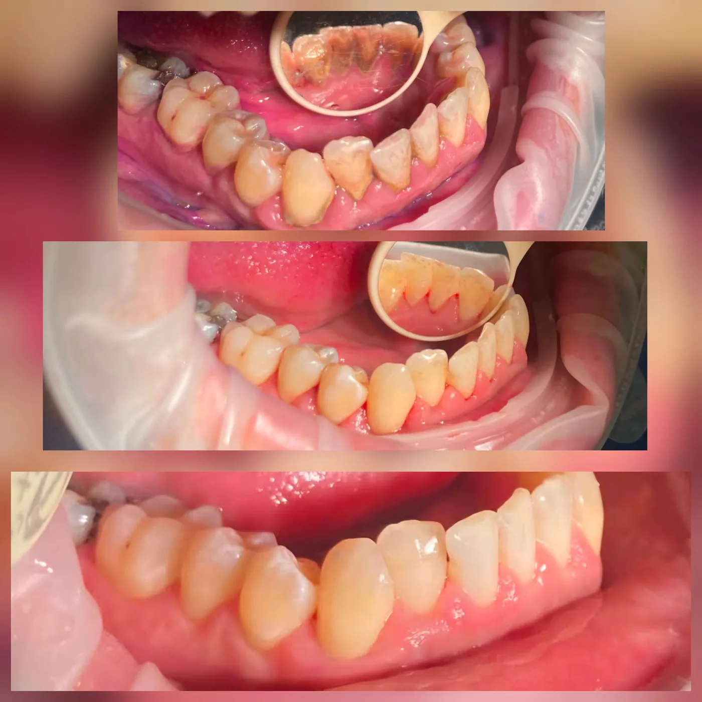 Dentální hygiena