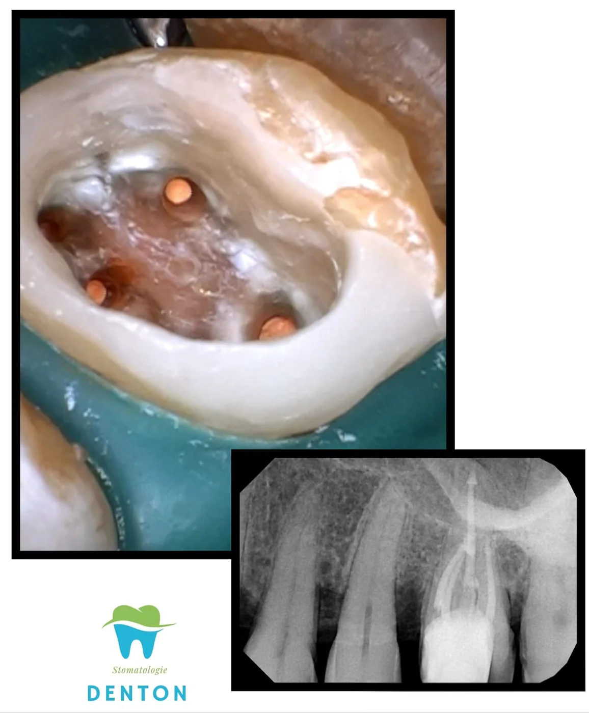 Endodoncie
